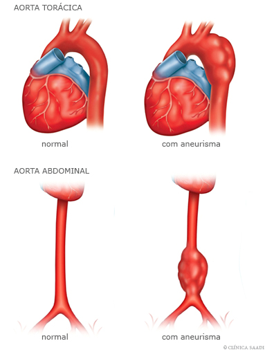 Aorta Torácica normaile com aneurisma e aorta abdominal normal e com aneurisma