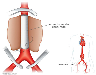 Cirurgia de Aneurismas da Aorta