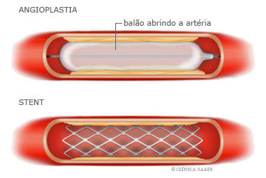 Angioplastia e stent no interior de uma artéria