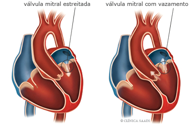 Válvulas cardíacas com funcionamento defeituoso. Valvulopatias
﻿