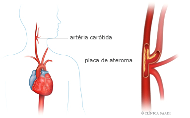Artéria Carótida e placa de ateroma