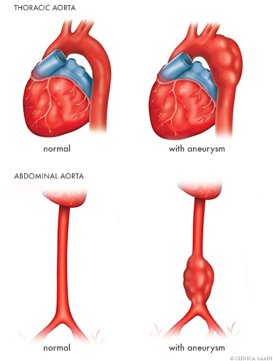Aneurysms of thoracic and abdominal aorta.
