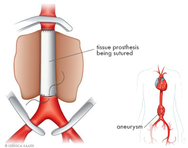 This is one of the two main forms of treatment of aortic aneurysms. In this traditional technique, there is need for opening the thorax or abdomen and transiently interrupt the blood flow in such aortic segment,