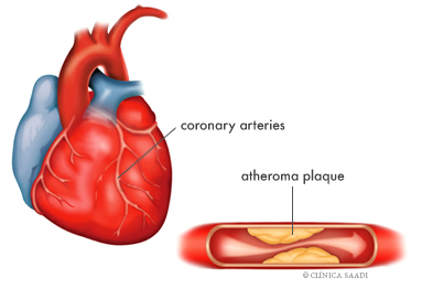 Ischemic cardiopathy