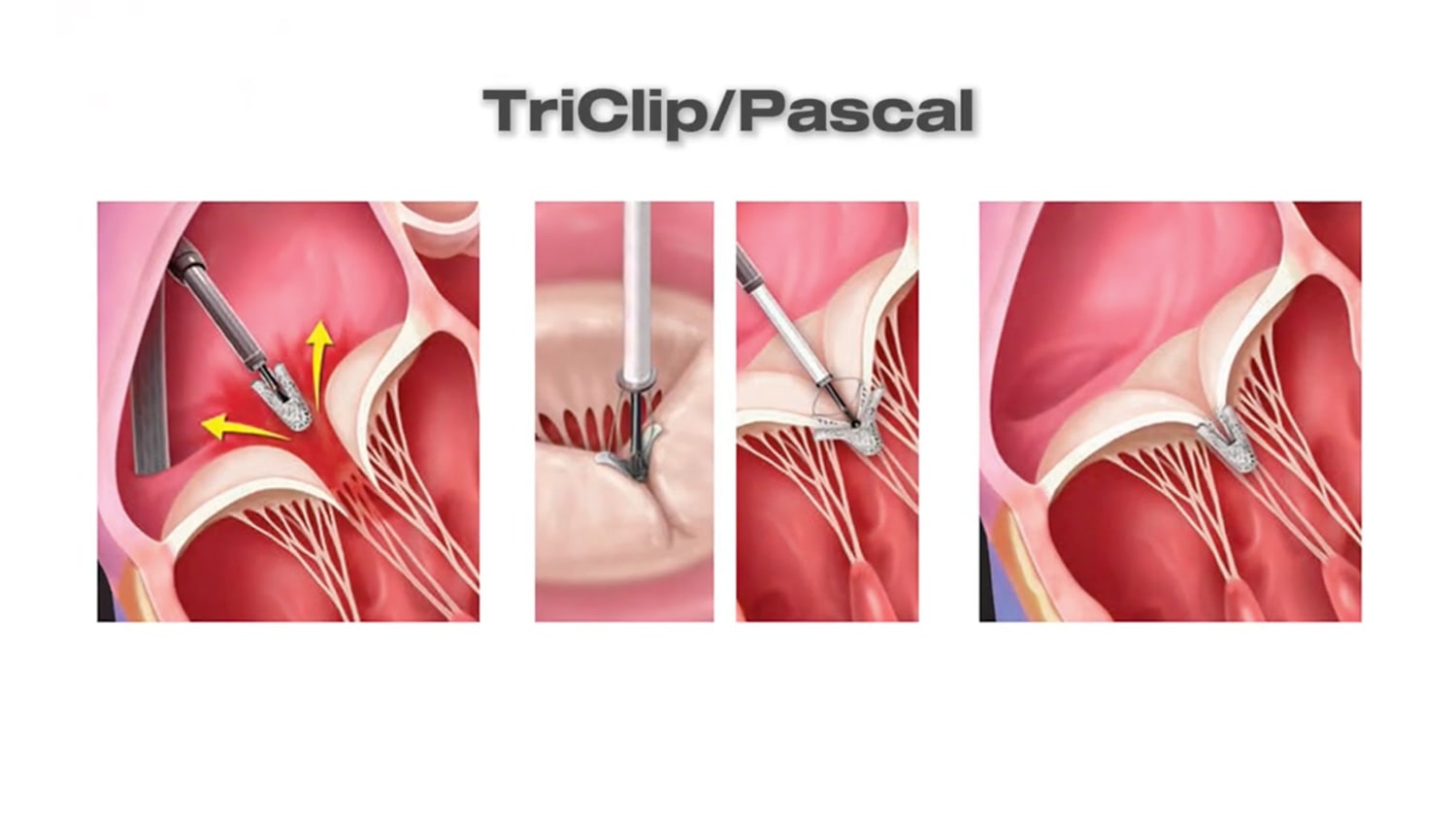 Tratamentos Transcateter TriClip e Pascal